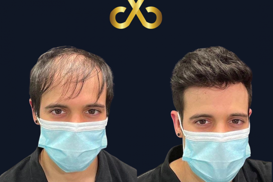 AMx Hair Replacement vs Hair Fibers Celebrity & Star Hair